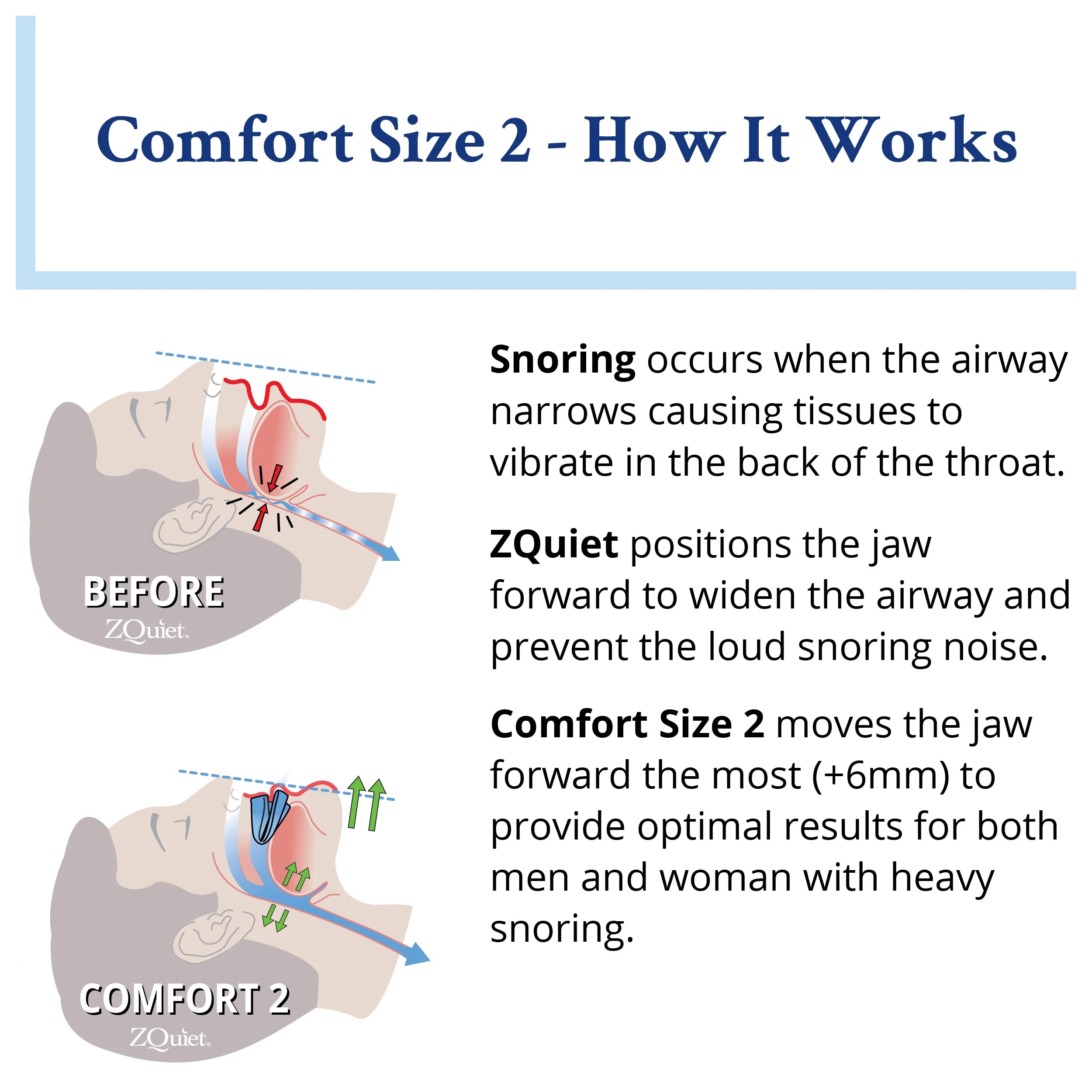 Anti-Snoring Mouthpiece Solution - Comfort Size #2 (Single Device) S31695