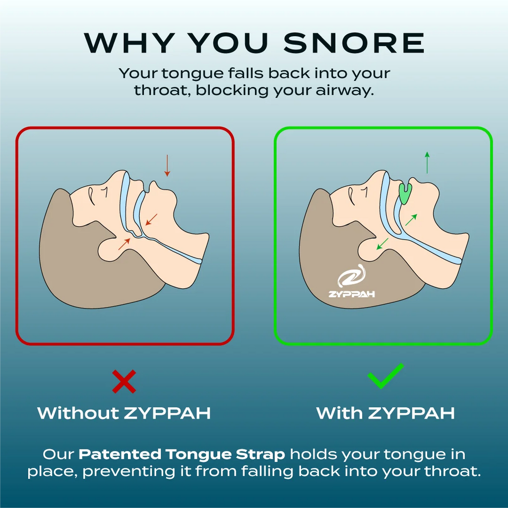 Anti Snoring Hybrid Oral Appliance V553012