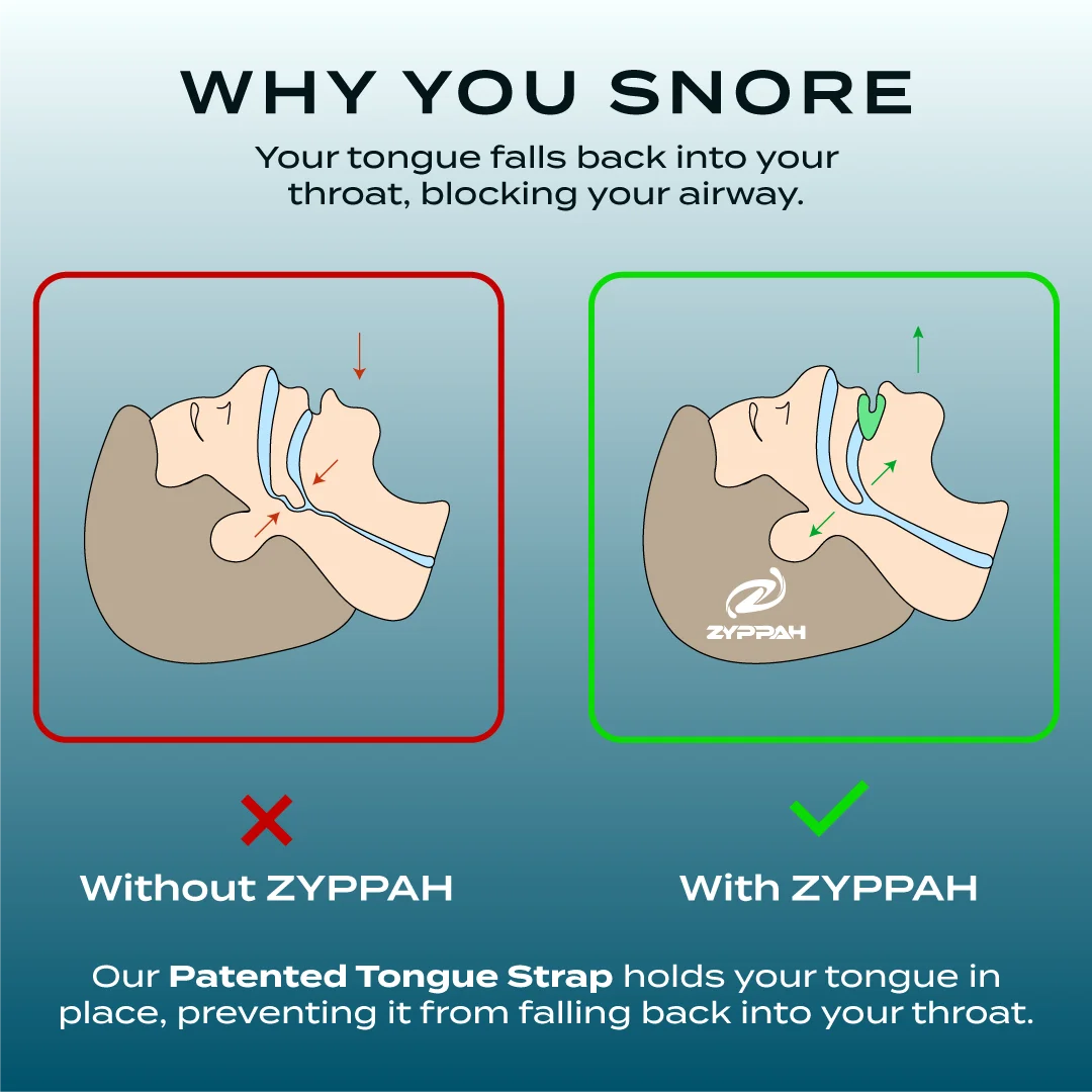 Anti Snoring Hybrid Oral Appliance V553012